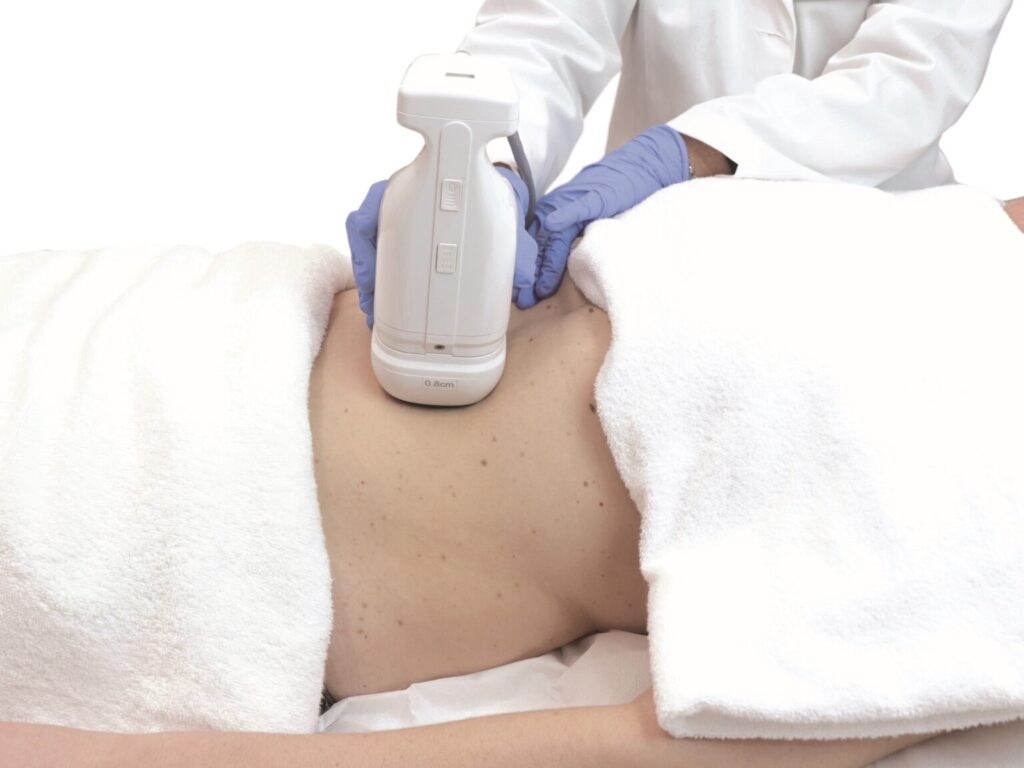 Trattamento corpo donna con ultrasuoni focalizzati ad alta intensità