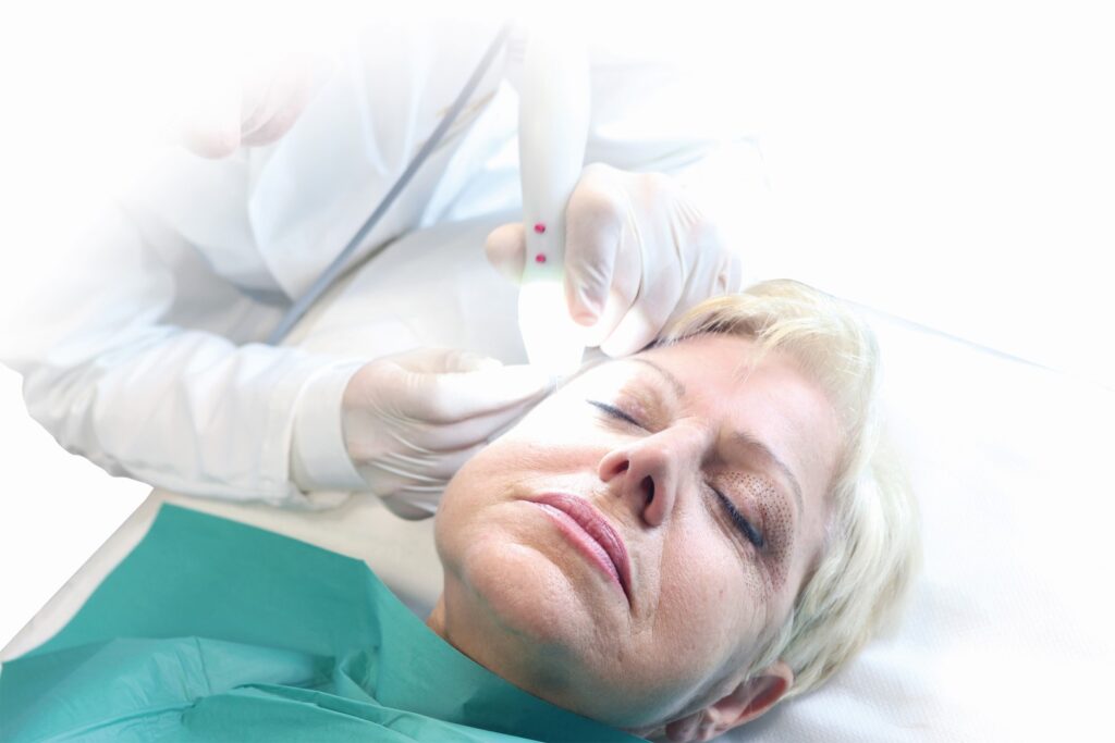 Trattamento radiofrequenza ablativa su volto donna